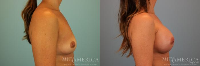Before & After Breast Augmentation Case 74 View #5 View in Glen Carbon, IL