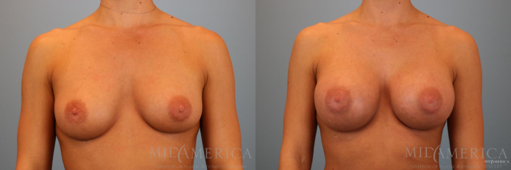 Before & After Breast Augmentation Case 88 View #1 View in Glen Carbon, IL
