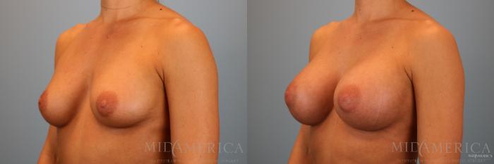 Before & After Breast Augmentation Case 88 View #2 View in Glen Carbon, IL