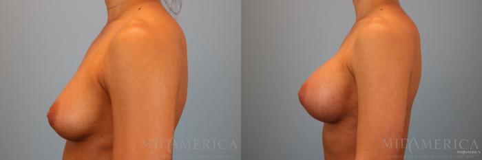Before & After Breast Augmentation Case 88 View #3 View in Glen Carbon, IL