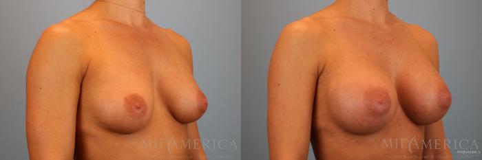 Before & After Breast Augmentation Case 88 View #4 View in Glen Carbon, IL