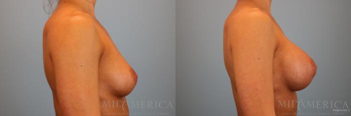 Before & After Breast Augmentation Case 88 View #5 View in Glen Carbon, IL