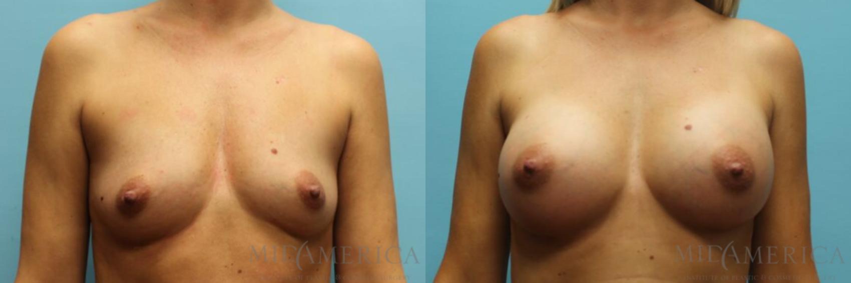 Before & After Breast Augmentation Case 93 View #1 View in St. Louis, MO