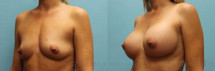 Before & After Breast Augmentation Case 93 View #2 View in St. Louis, MO