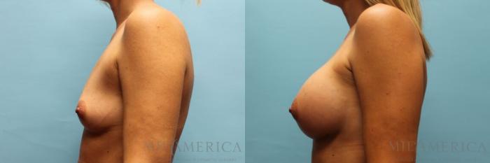 Before & After Breast Augmentation Case 93 View #3 View in St. Louis, MO
