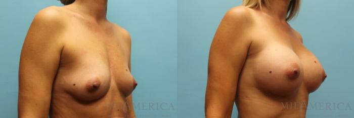 Before & After Breast Augmentation Case 93 View #4 View in St. Louis, MO