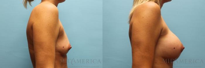 Before & After Breast Augmentation Case 93 View #5 View in St. Louis, MO