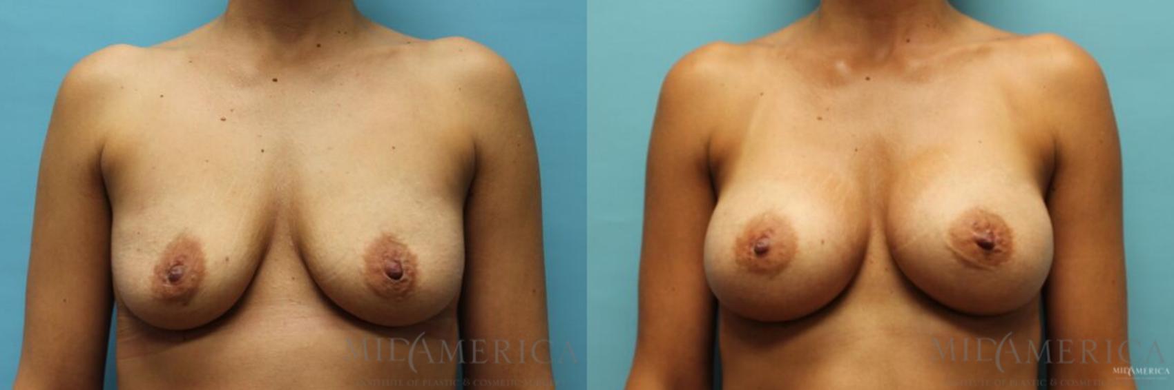 Before & After Breast Augmentation Case 94 View #1 View in Glen Carbon, IL