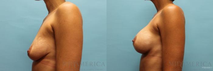 Before & After Breast Augmentation Case 94 View #3 View in St. Louis, MO