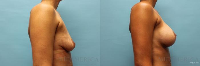 Before & After Breast Augmentation Case 94 View #5 View in St. Louis, MO
