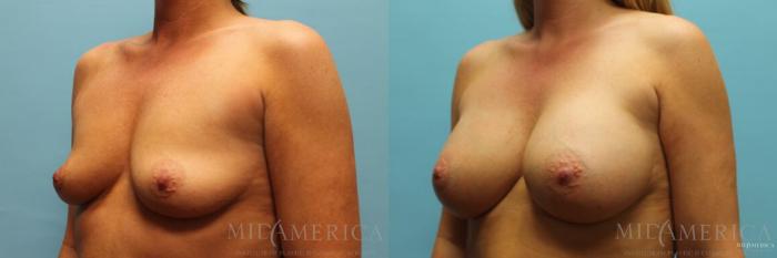 Before & After Breast Augmentation Case 97 View #2 View in St. Louis, MO