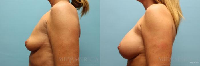 Before & After Breast Augmentation Case 97 View #3 View in St. Louis, MO
