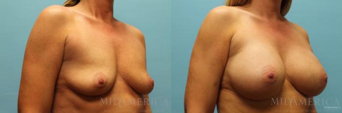 Before & After Breast Augmentation Case 97 View #4 View in St. Louis, MO