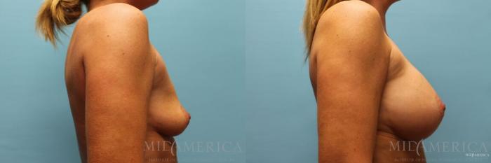 Before & After Breast Augmentation Case 97 View #5 View in St. Louis, MO