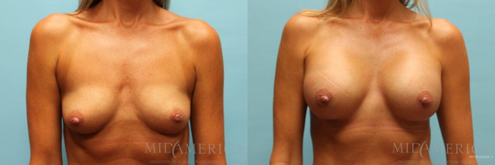 Before & After Breast Augmentation Case 98 View #1 View in Glen Carbon, IL