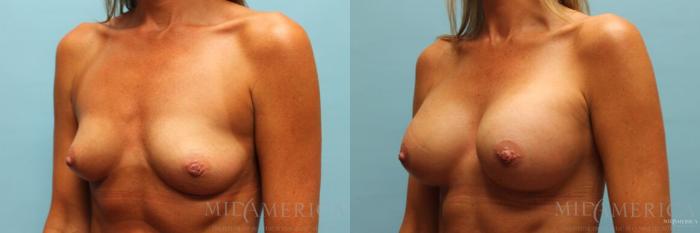 Before & After Breast Augmentation Case 98 View #2 View in St. Louis, MO