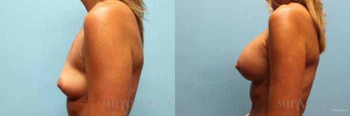 Before & After Breast Augmentation Case 98 View #3 View in St. Louis, MO