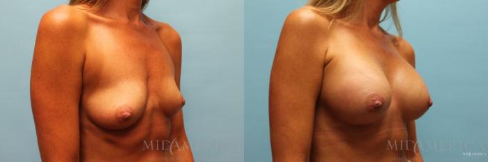 Before & After Breast Augmentation Case 98 View #4 View in St. Louis, MO