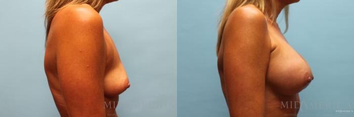 Before & After Breast Augmentation Case 98 View #5 View in St. Louis, MO