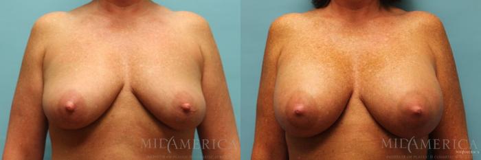Before & After Breast Augmentation Case 99 View #1 View in St. Louis, MO