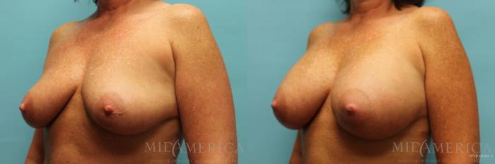 Before & After Breast Augmentation Case 99 View #2 View in St. Louis, MO
