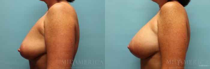 Before & After Breast Augmentation Case 99 View #3 View in St. Louis, MO