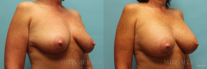 Before & After Breast Augmentation Case 99 View #4 View in St. Louis, MO