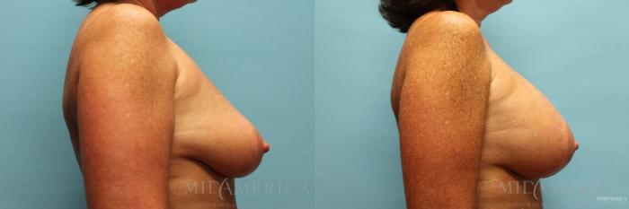 Before & After Breast Augmentation Case 99 View #5 View in St. Louis, MO