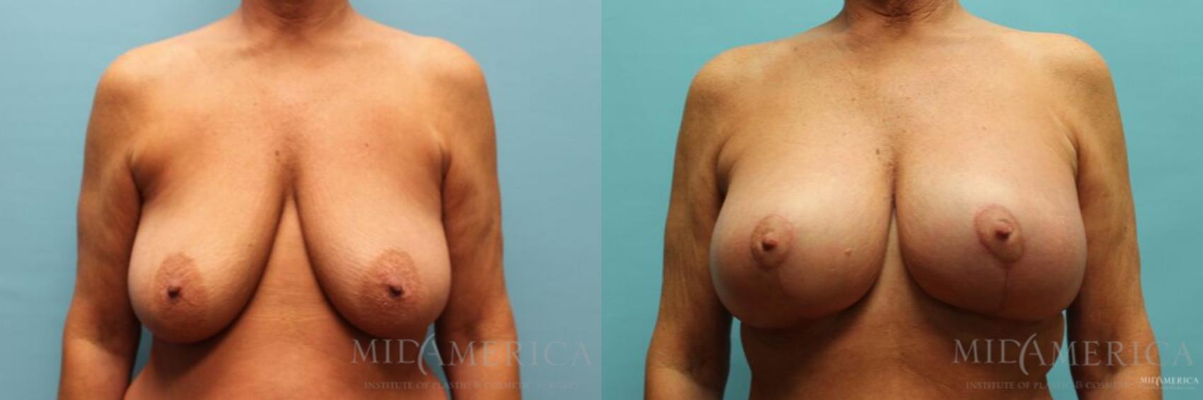 Before & After Breast Lift Case 116 View #1 View in Glen Carbon, IL