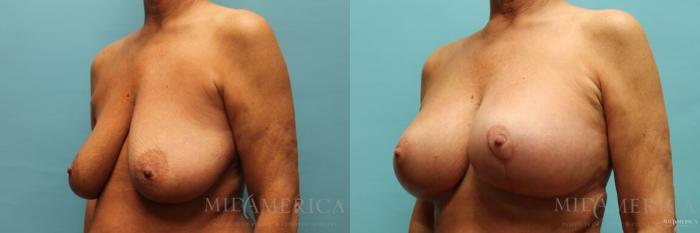 Before & After Breast Lift Case 116 View #2 View in St. Louis, MO