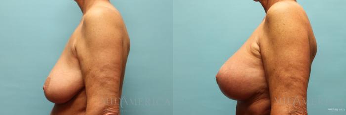 Before & After Breast Lift Case 116 View #3 View in St. Louis, MO