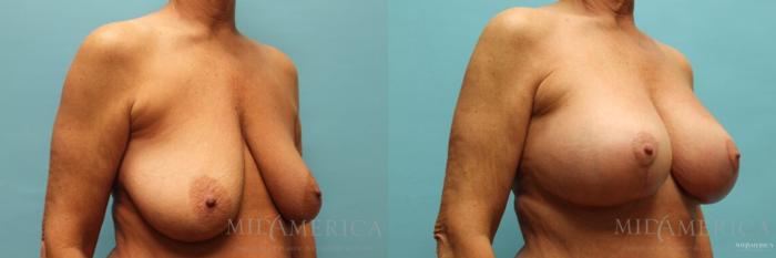 Before & After Breast Lift Case 116 View #4 View in St. Louis, MO
