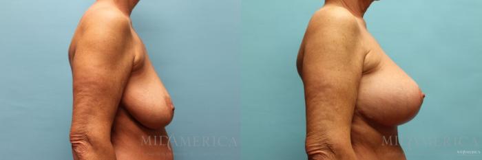 Before & After Breast Lift Case 116 View #5 View in St. Louis, MO