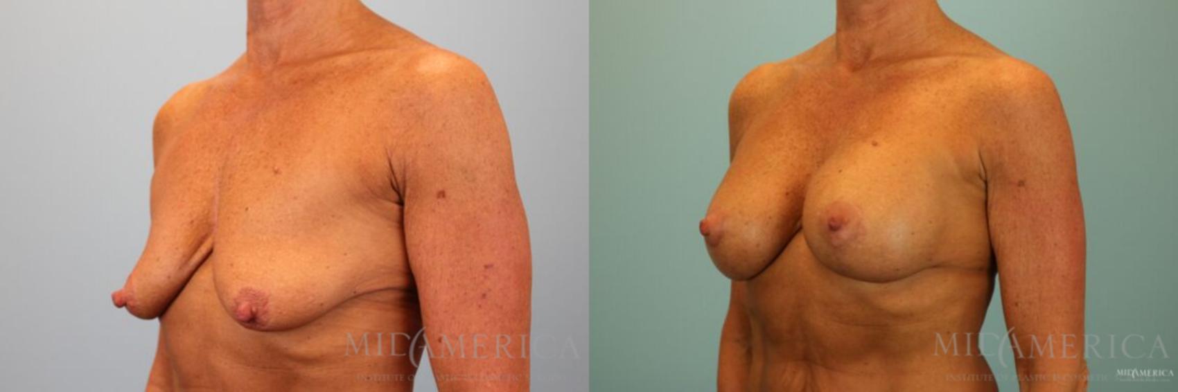 Before & After Breast Lift Case 128 View #2 View in Glen Carbon, IL