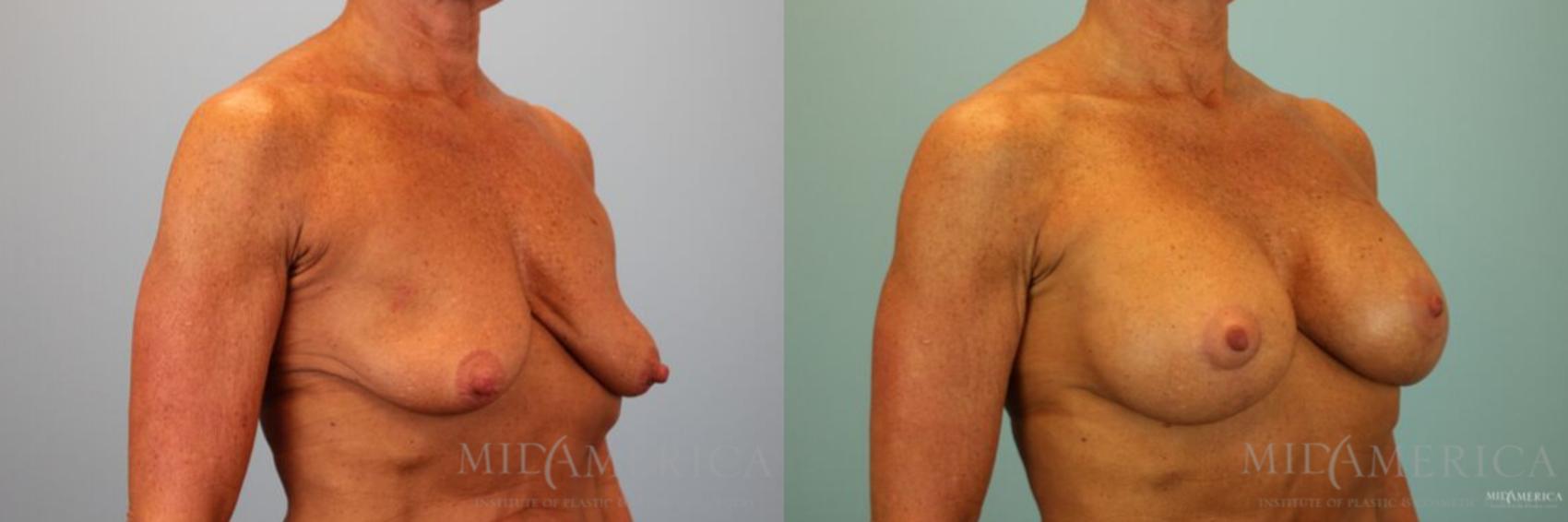 Before & After Breast Lift Case 128 View #4 View in Glen Carbon, IL