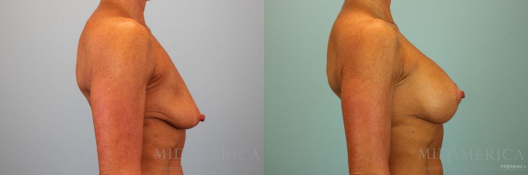 Before & After Breast Lift Case 128 View #5 View in Glen Carbon, IL