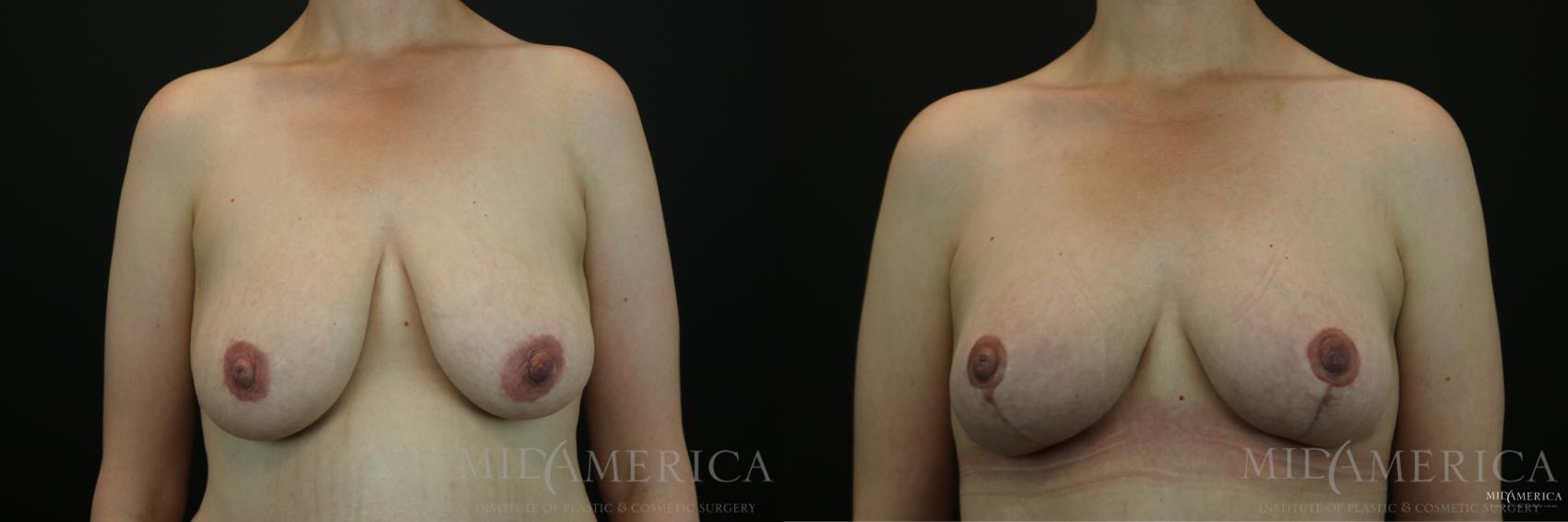 Before & After Breast Lift Case 143 View #1 View in Glen Carbon, IL