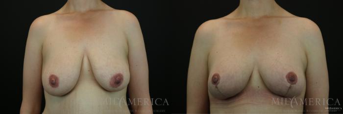 Before & After Breast Lift Case 143 View #1 View in St. Louis, MO