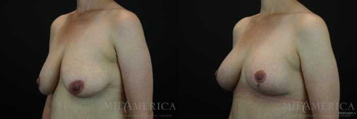 Before & After Breast Lift Case 143 View #2 View in St. Louis, MO
