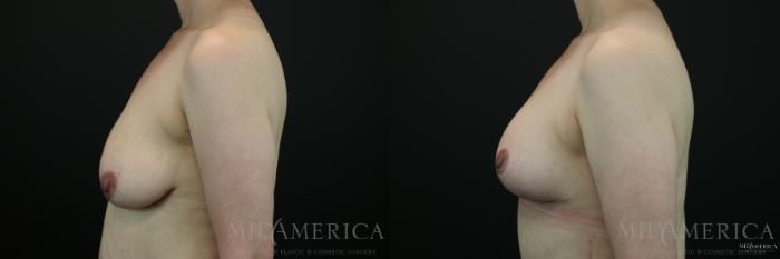Before & After Breast Lift Case 143 View #3 View in St. Louis, MO