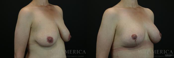 Before & After Breast Lift Case 143 View #4 View in St. Louis, MO