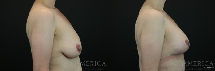 Before & After Breast Lift Case 143 View #5 View in St. Louis, MO