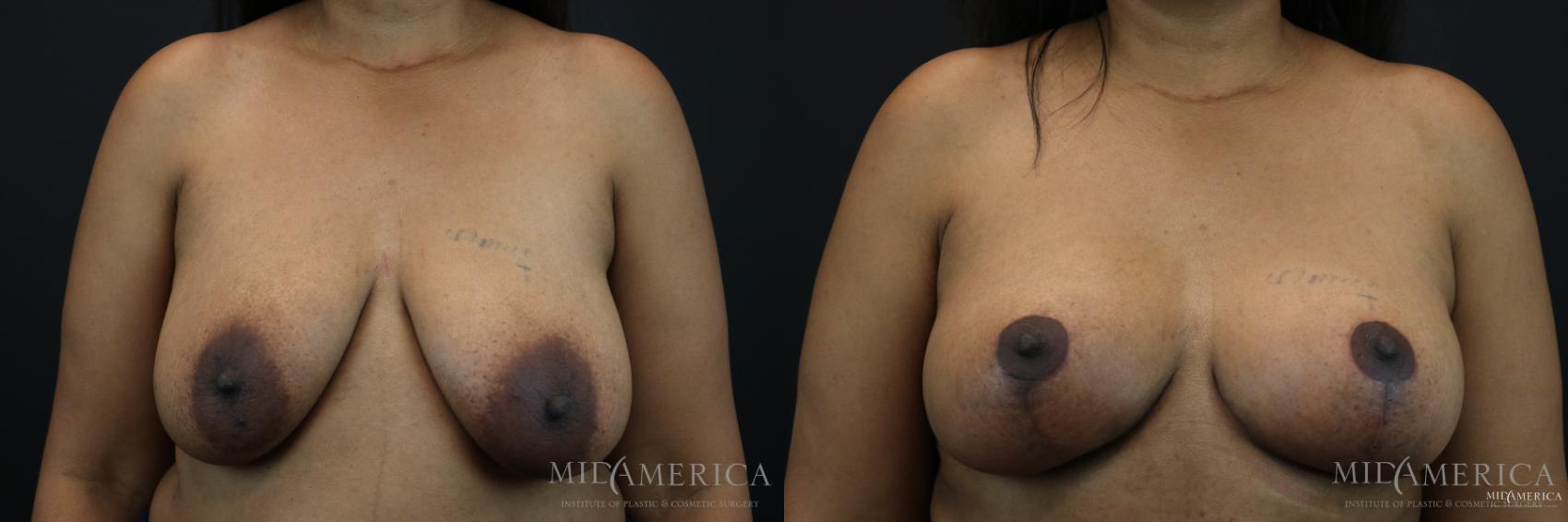 Before & After Breast Lift Case 147 View #1 View in Glen Carbon, IL