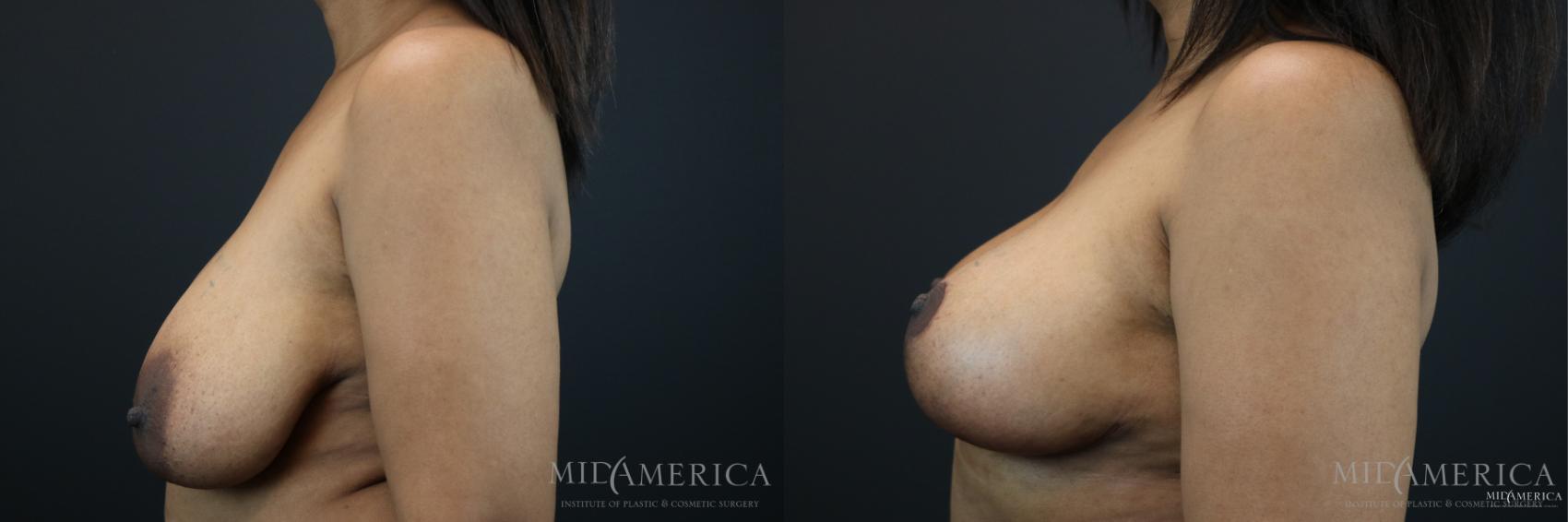 Before & After Breast Lift Case 147 View #3 View in Glen Carbon, IL