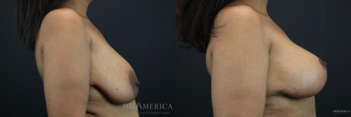 Before & After Breast Lift Case 147 View #5 View in St. Louis, MO