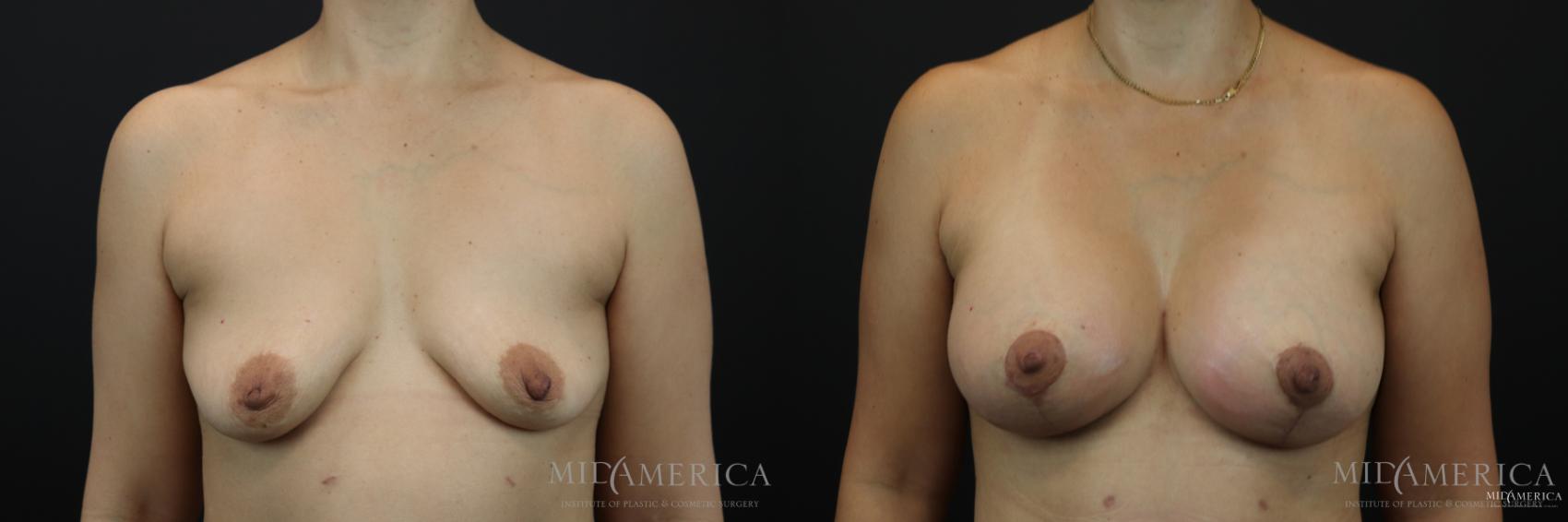 Before & After Breast Lift Case 168 View #1 View in Glen Carbon, IL