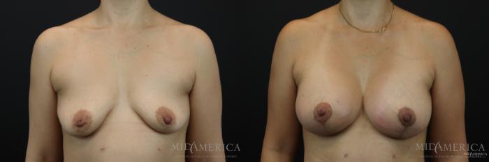 Before & After Breast Lift Case 168 View #1 View in St. Louis, MO