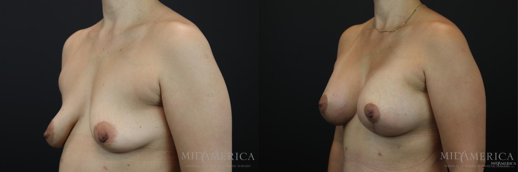 Before & After Breast Lift Case 168 View #2 View in Glen Carbon, IL