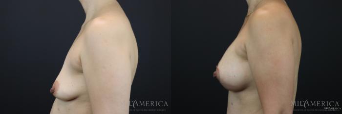 Before & After Breast Lift Case 168 View #3 View in St. Louis, MO