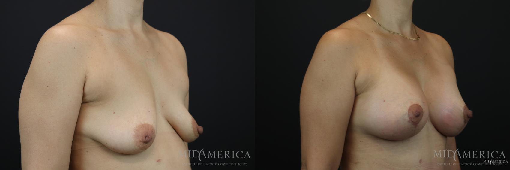 Before & After Breast Lift Case 168 View #4 View in Glen Carbon, IL